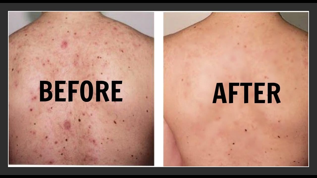 This Is How to Get Rid of Back Acne Fast, Safe And Easy! 