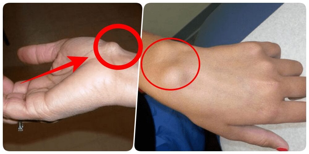 Is A Bump On Your Wrist A Cause For Concern? SEE WHAT TO DO!